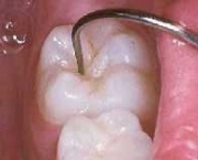 Dente vulnervel  crie dentria
